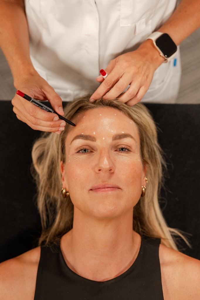 Behandelmarkering voor een botox behandeling